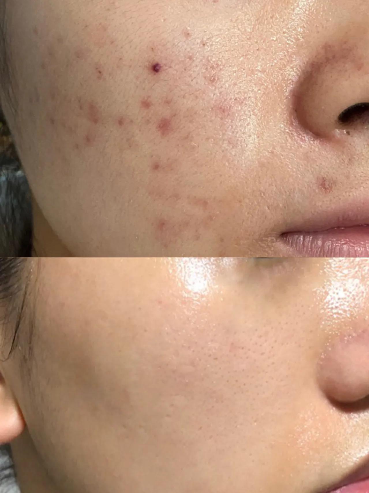 油痘肌不长痘痘了是不是快好了,油痘肌的痘痘