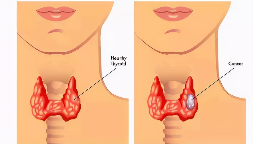 甲状腺结节你不得不知的三个问题,甲状腺结节其实没那么可怕