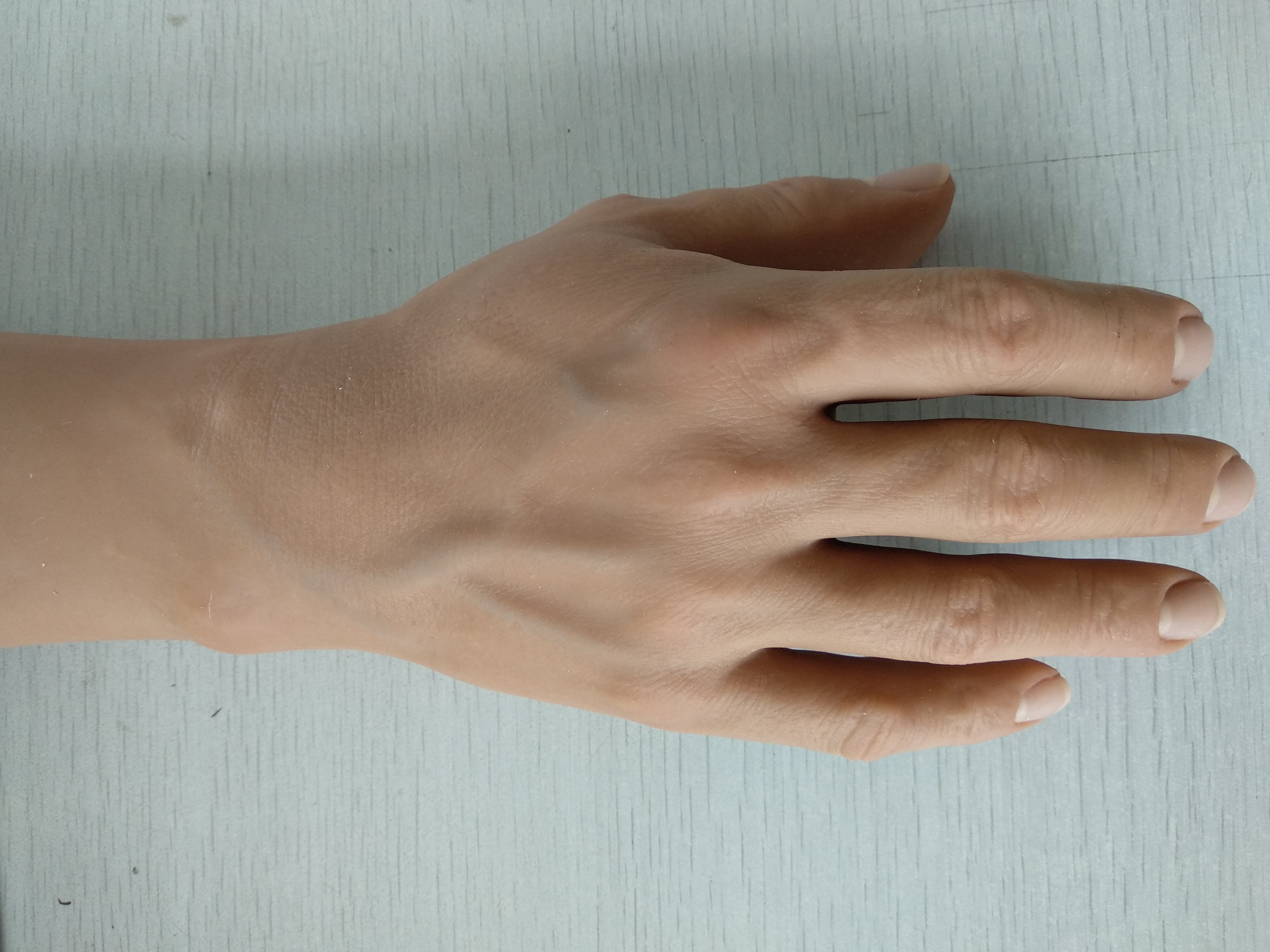 截肢后戴假肢老是疼怎么处理,截肢病人注意事项