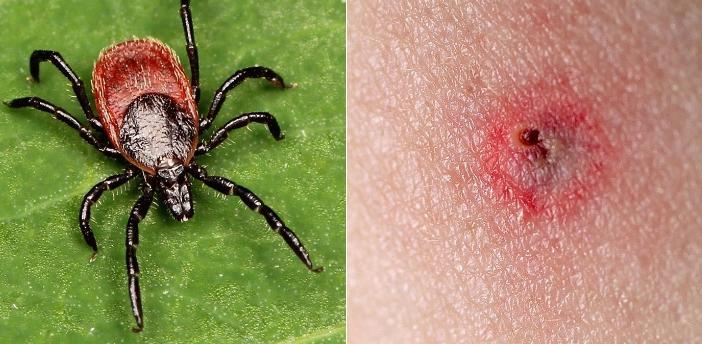 日本新型病毒是真的吗,蜱虫传染的新型病毒