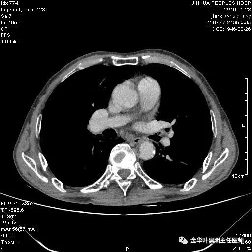 手术引起乳糜胸,有没有做了肺结节手术后是误诊的