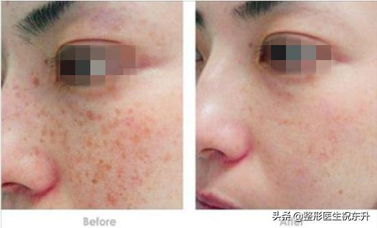 医生不会说的祛斑,医生不建议做光子美容