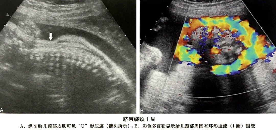 胎儿脐带绕颈有什么症状,胎儿脐带绕颈的症状有哪些