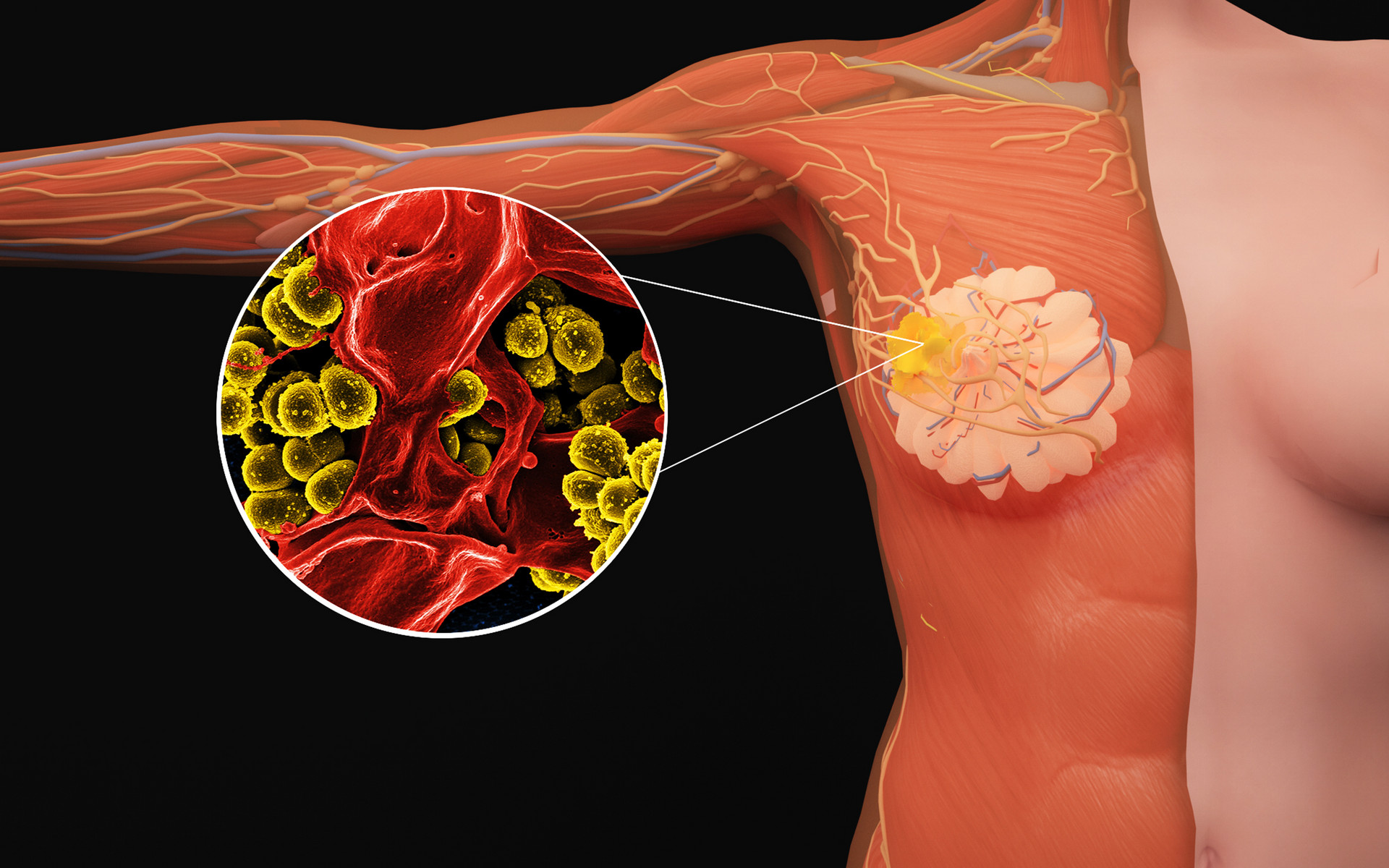 为什么原位癌属于轻症,原位癌是什么意思为什么保险不赔