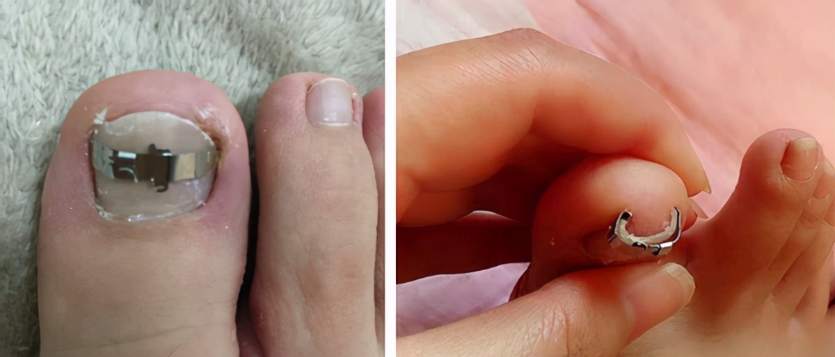 拔甲可以彻底治好嵌甲性甲沟炎吗,嵌甲甲沟炎拔了指甲还是红肿有脓