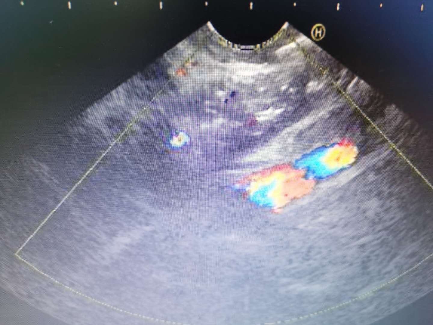 *安泰**市中心医院肝胆胰腺内科一新技术填补*安泰**空白