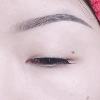 单眼皮凸嘴素人改造,肿眼泡整容成功案例