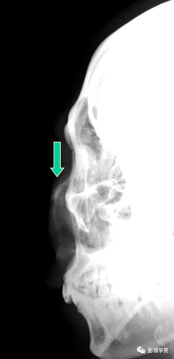鼻骨骨折的检查方法,鼻骨骨折影像学表现