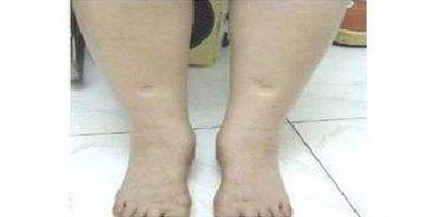 小腿和大腿都粗该怎么瘦腿,小腿太细腿弯怎么练