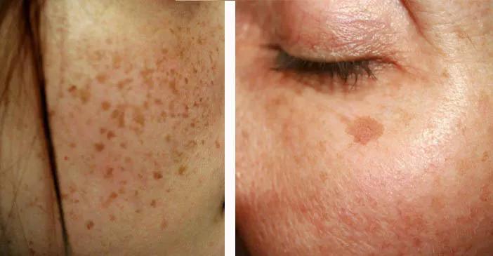 祛色斑的小窍门,色斑严重学会这几招省钱又有效