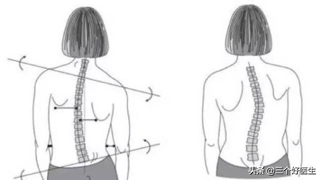 脊椎错位现场如何处理,脊椎错位矫正方法图解