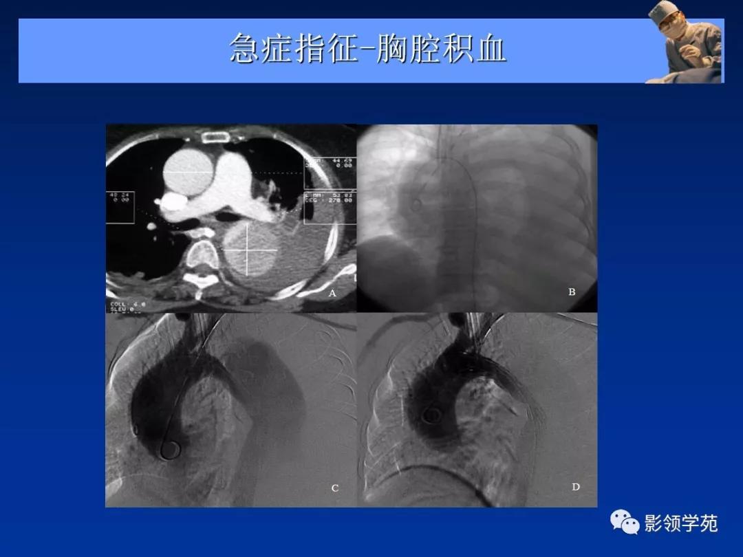 主动脉夹层壁间血肿如何鉴别,主动脉夹层血肿溃疡