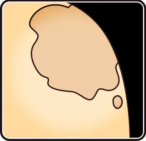 黑毛胎记科普,长满胎记的人