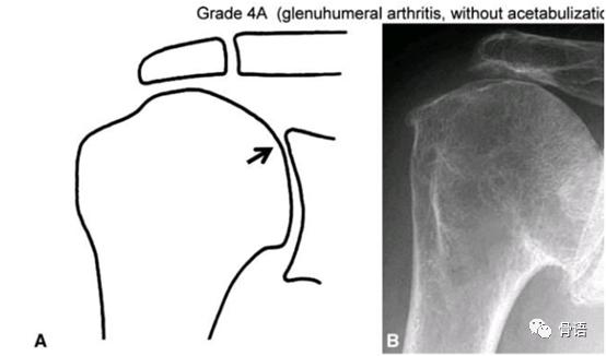 巨大肩袖撕裂概念图,右肩袖巨大撕裂