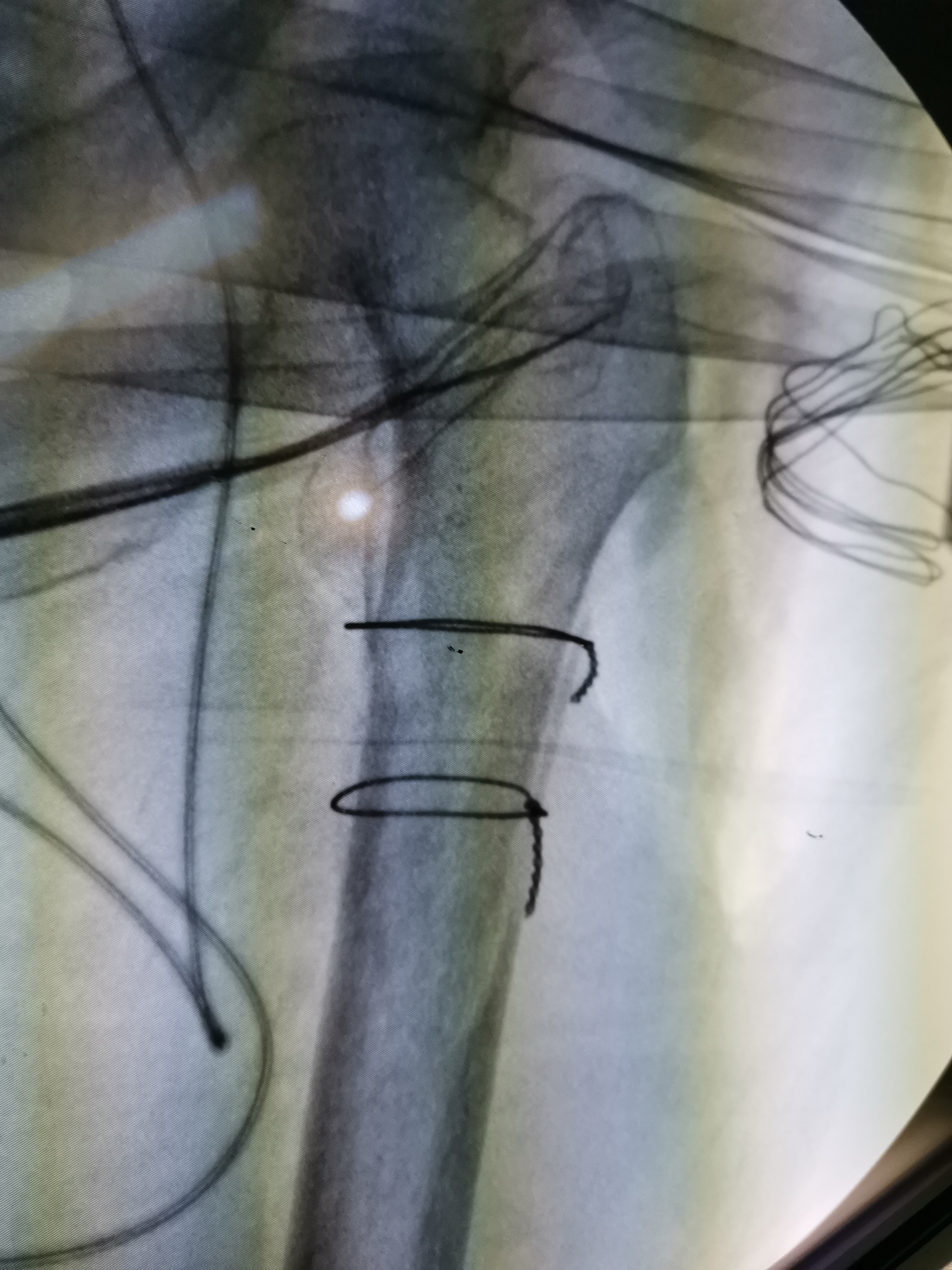 老人摔一跤屁股骨折,老人一屁股坐在地上大腿骨折