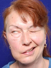 张医生治病救人后续,左眼皮一直跳咋回事好像痉挛