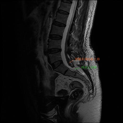 脊髓栓系综合征如何缓解,做了脊髓栓系综合征会有后遗症吗