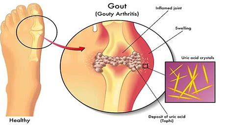 辟谣:痛风非布司他副作用大,尽量不服用。医生讲清楚用药细节
