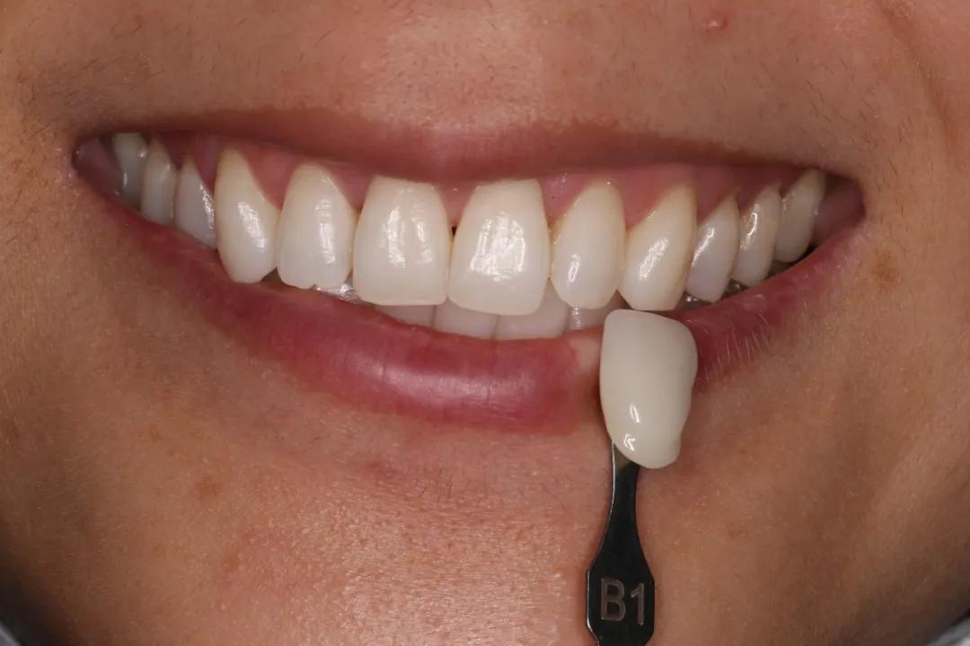 牙齿美白这个行业靠谱吗,柠檬美白牙齿靠谱吗