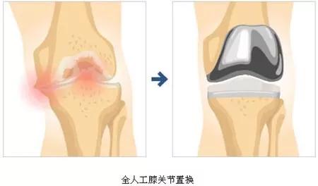 膝盖疼都是哪些部位,膝盖疼怎么区分是哪个部位有问题