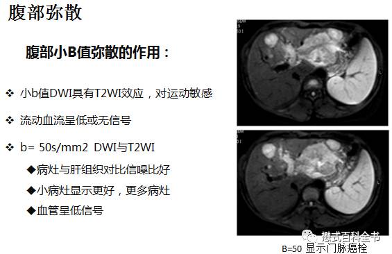 dwi成像序列,dwi序列和edwi序列