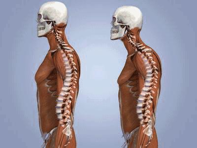 骨盆前倾驼背溜肩,怎样纠正驼背和脖子前倾溜肩