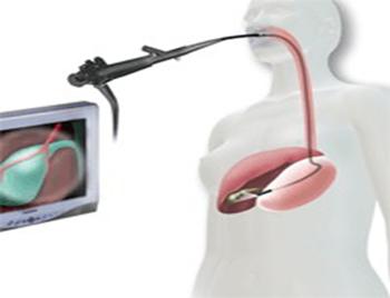 微创胆囊切除后伤口多久彻底愈合,胆囊切除是小手术吗