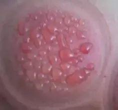 拔罐有水泡和血泡是代表什么,如何快速缓解拔罐出现的印子