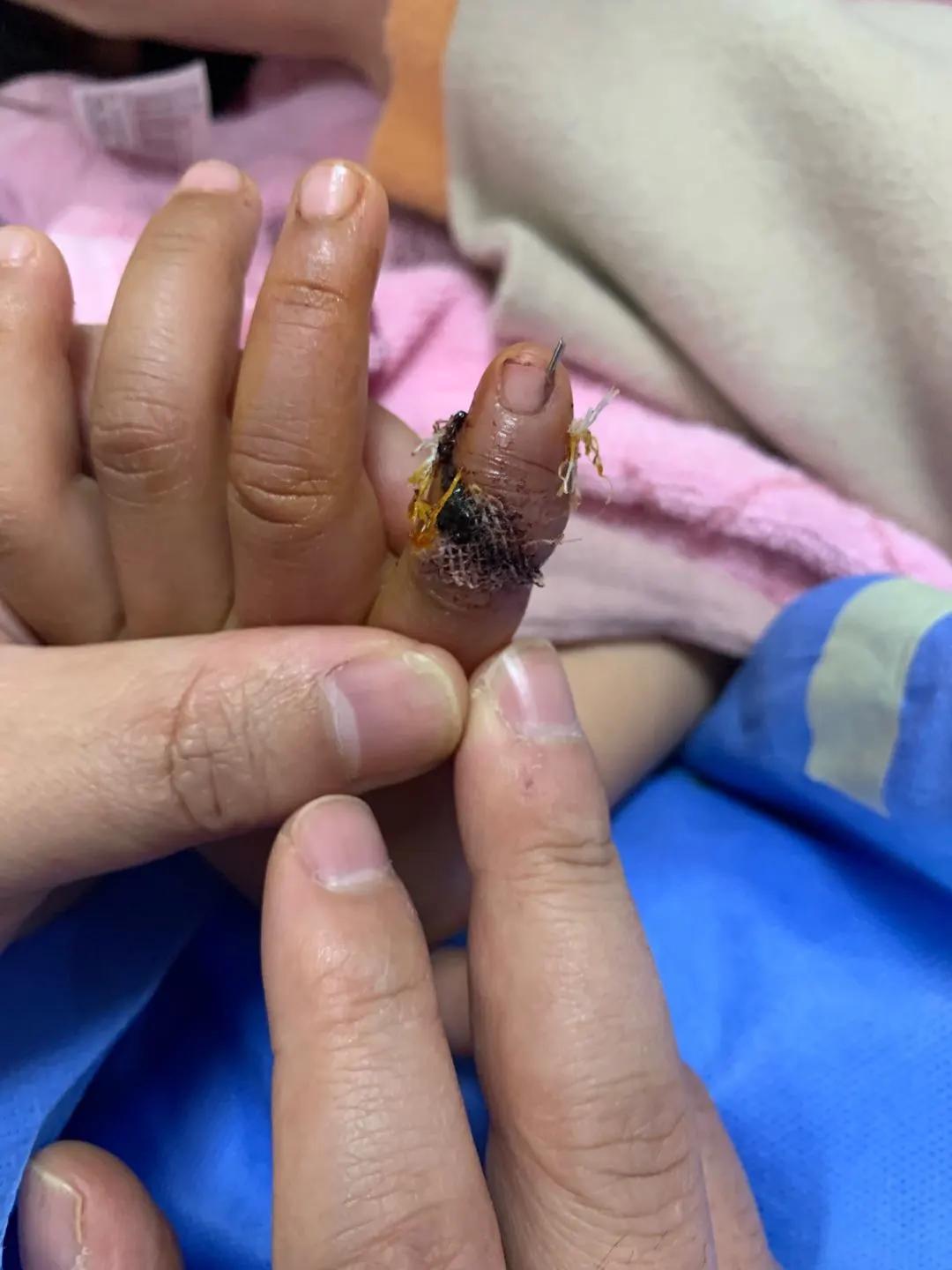 断指再植接动脉显微镜视频,穿针引线手术