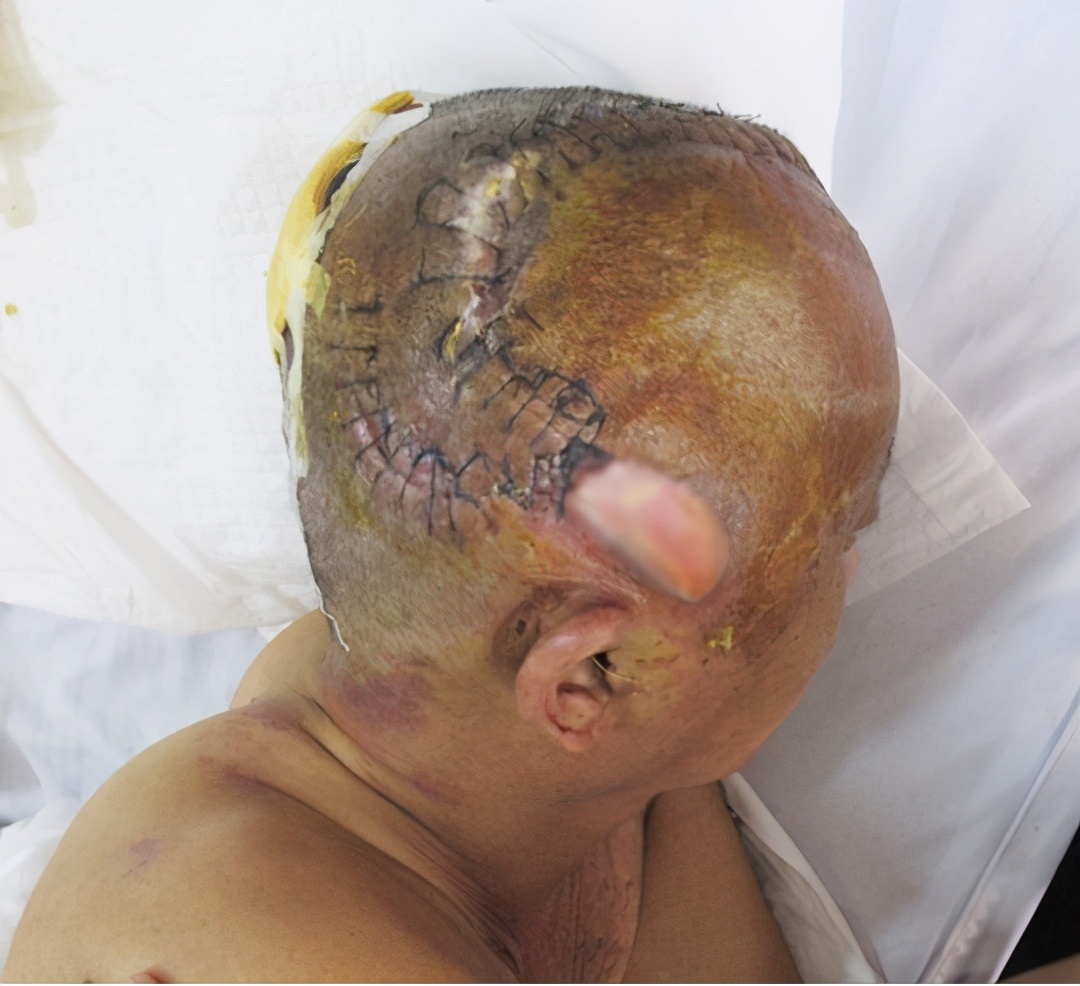 脑外伤开颅手术后脑积水,脑外伤手术后脑脊液鼻漏怎么治疗