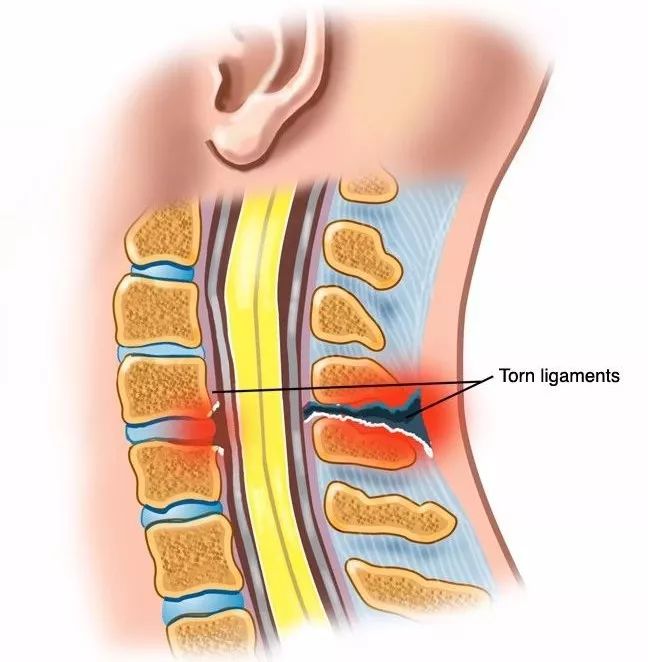 瑜伽拉伸不是拉韧带，韧带拉伤后果很严重