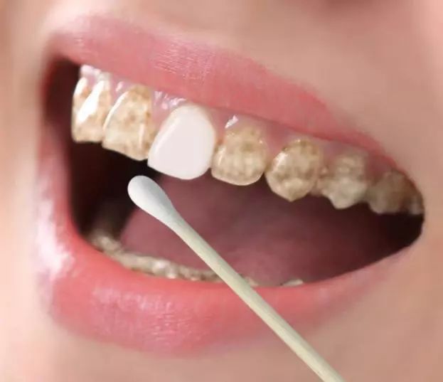 刷牙怎么掉一块牙结石,刷牙如何刷掉牙垢和脏东西