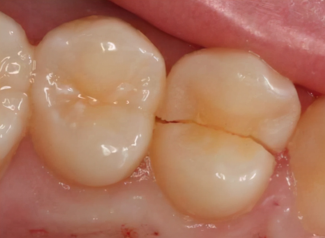 根管治疗后戴牙冠有后悔的吗,做完根管治疗不戴牙冠和戴了区别