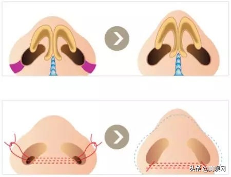 明星都在用的缩小鼻翼神器,明星鼻子做鼻翼缩小外切