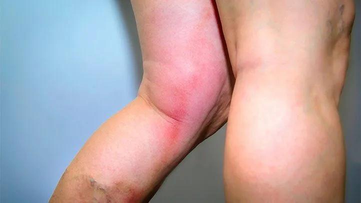 小腿内侧肌肉疼康复训练,拉伸腓肠肌小腿前侧痛原因