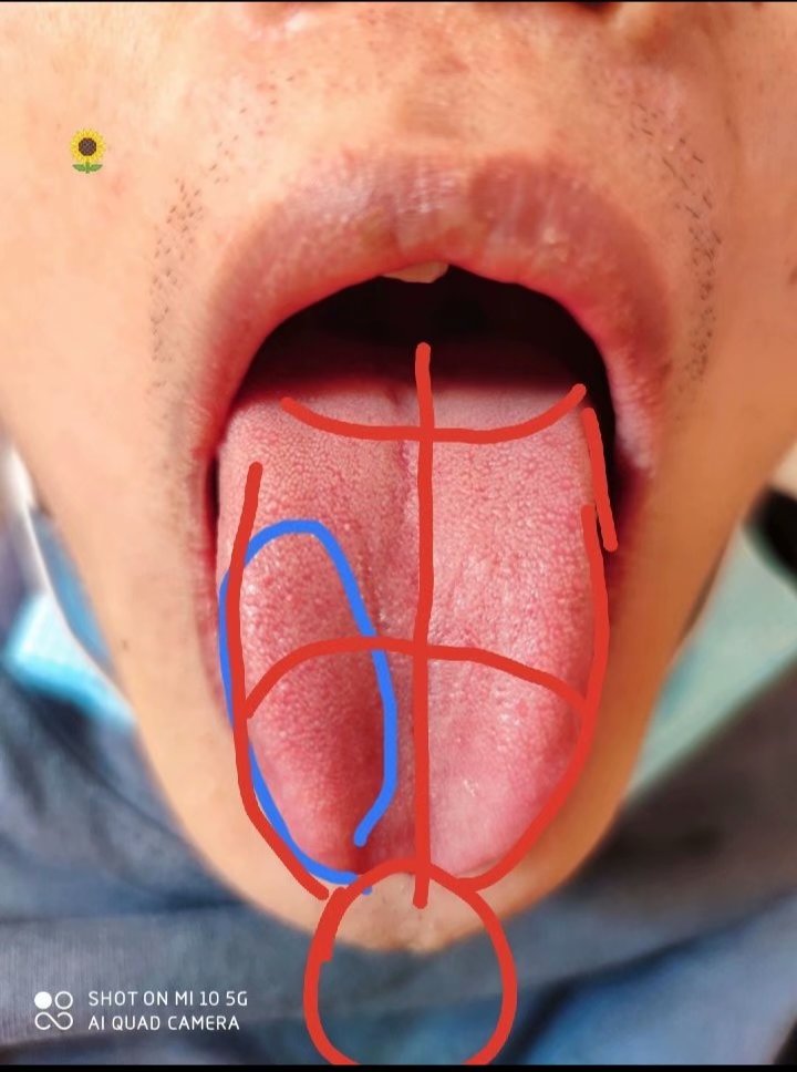 舌诊图解与针灸治疗,古法针灸点穴大全视频