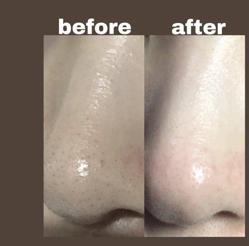 去黑头粉刺简单有效的方法,去黑头粉刺超级治愈