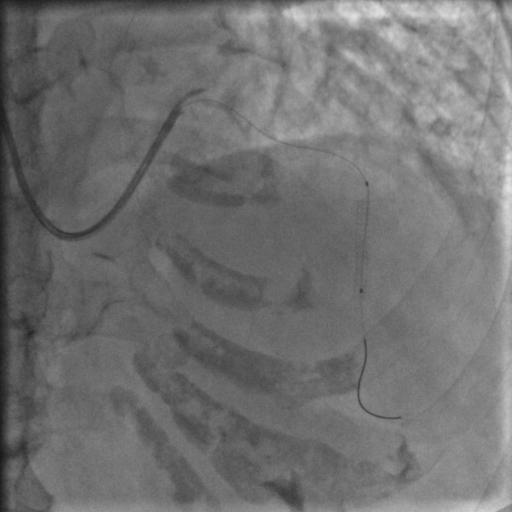85岁老人心脏堵塞,77岁老人冠脉狭窄放支架还是搭桥