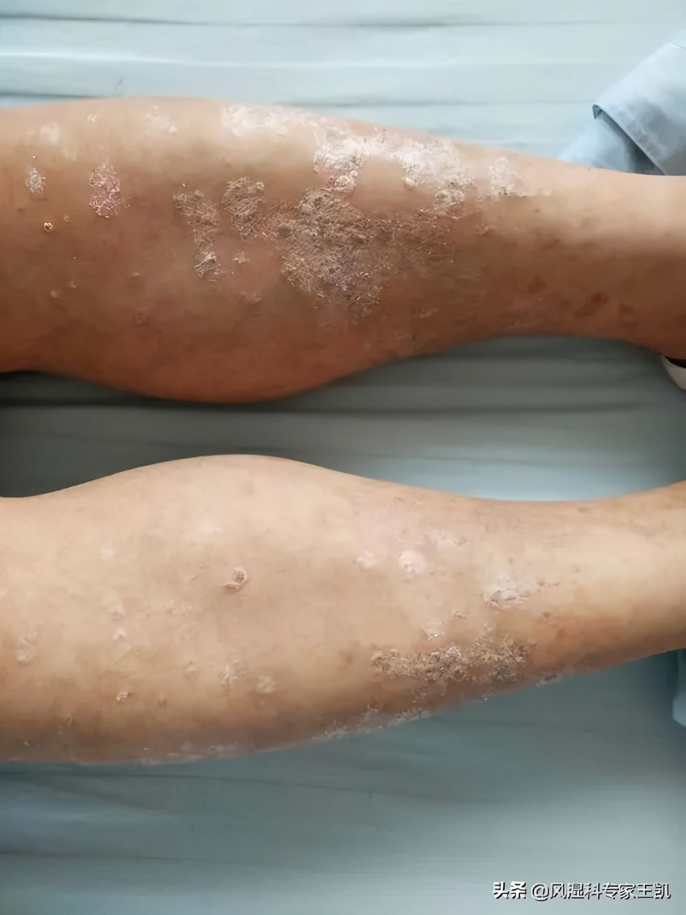 类风湿关节炎的先兆,类风湿关节炎能治愈吗