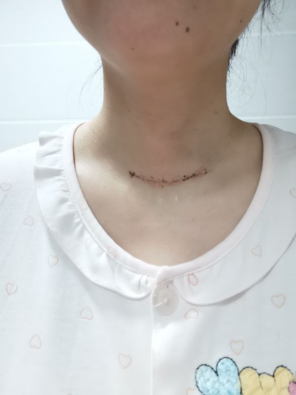 术后第二天安全渡过,术后的第十五天