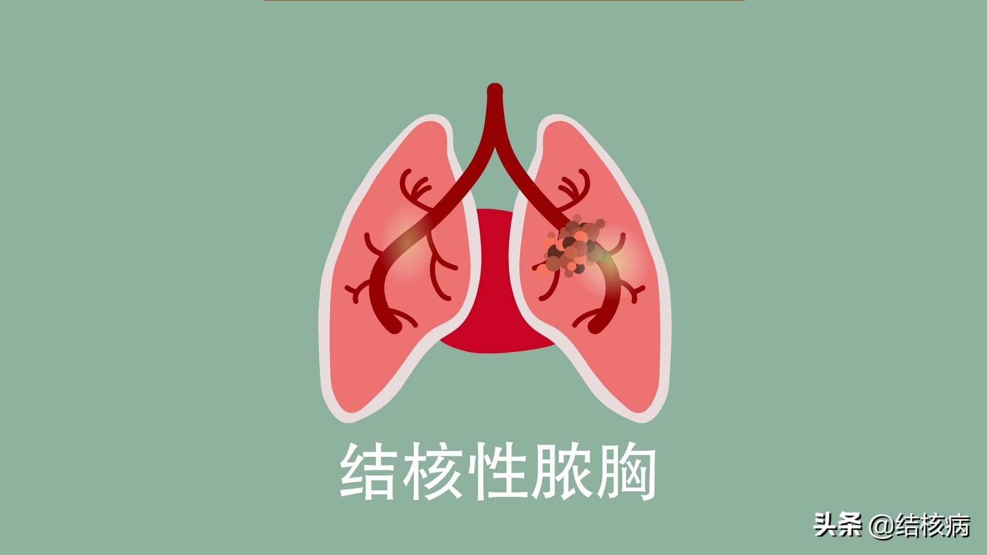 结核病的各种合并症和并发症,结核病有哪些并发症