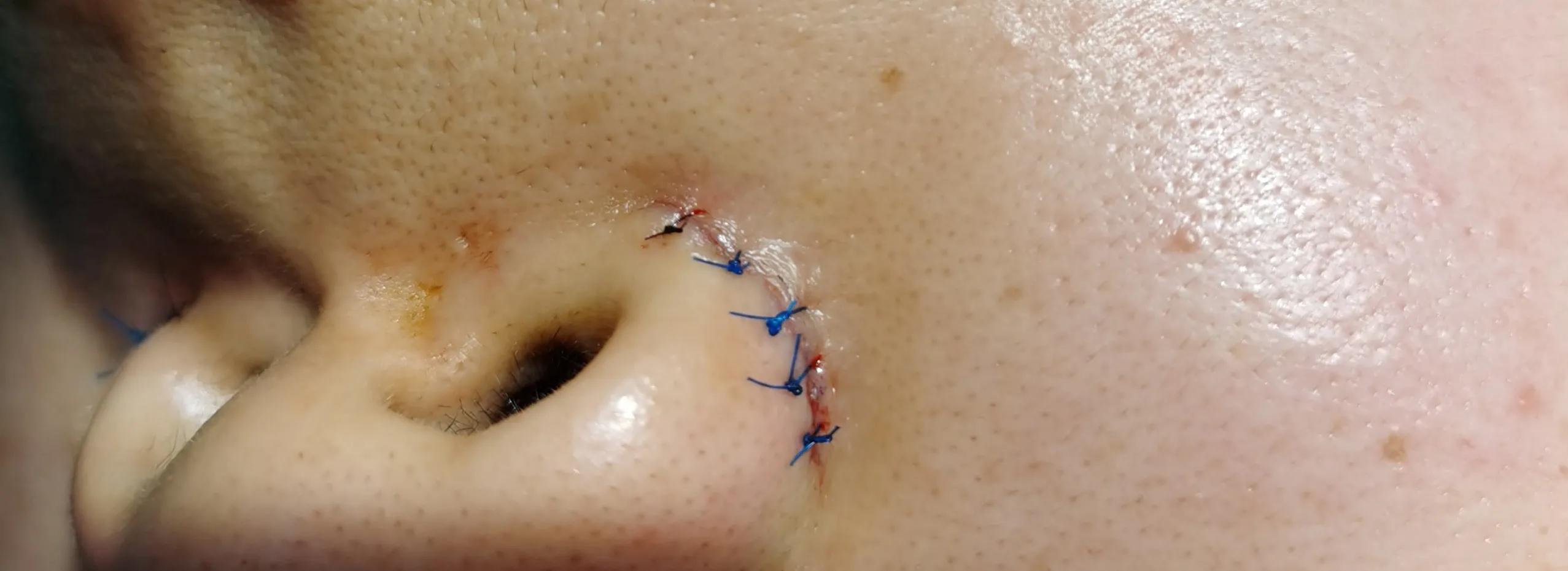 整形医生做面部美容视频,鼻头鼻翼缩小术的真实案例