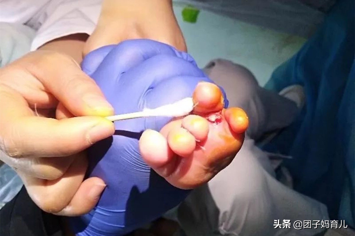 小孩单个脚趾肿胀一个月,宝宝的脚趾突然肿