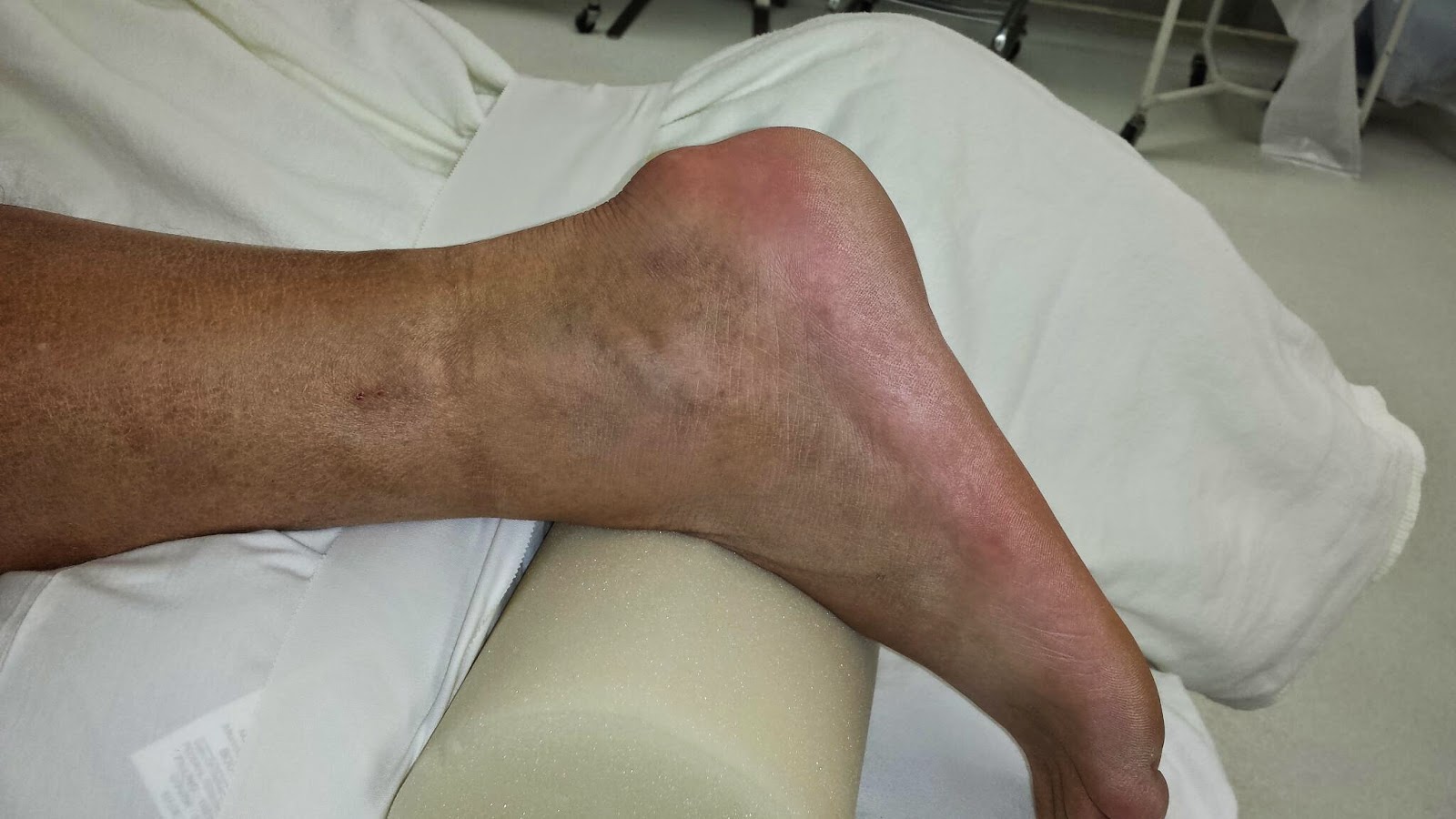 伸直后腿筋疼是怎么回事,前脚踝撞击综合征怎么治疗