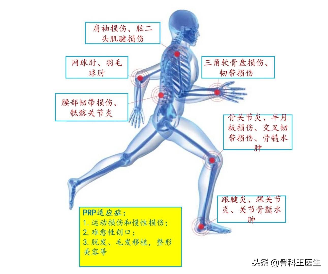 指南推荐！关节炎新疗法，PRP到底是何方神圣？