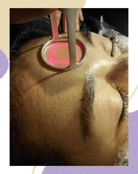 医美做什么能永远不长痘,脸很多痘坑做什么医美