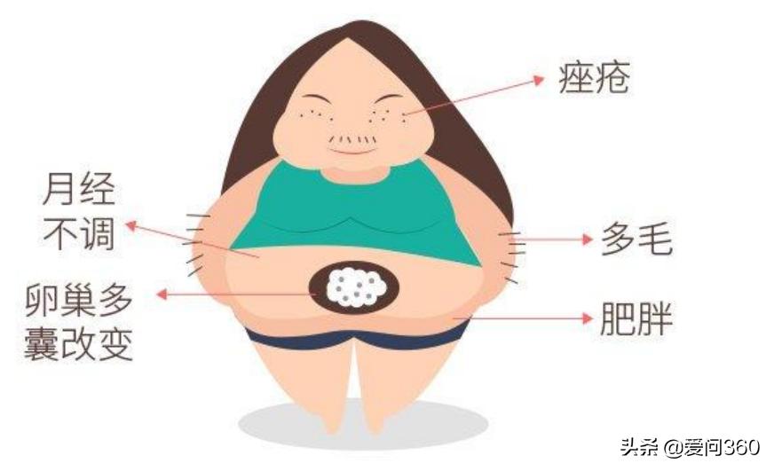 多囊卵巢综合征七大症状快来自测,多囊卵巢综合征的10大症状