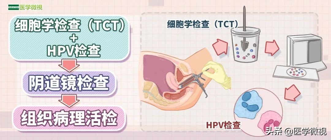 宫颈癌tct检查结果显示有轻度炎症,宫颈癌tct报告单可见挖空细胞