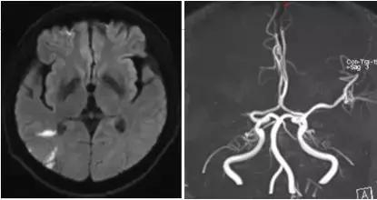 一人中风，全家“发疯”，脑梗5天，还能恢复吗？
