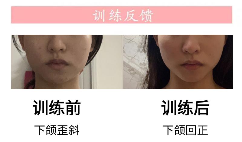 从下颚后缩到完美侧颜,侧颜杀杀手